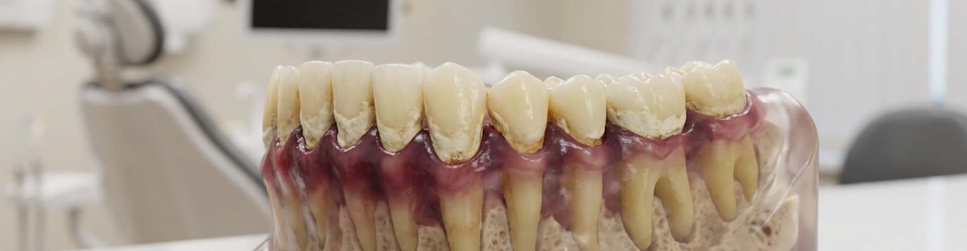 Model of jaw with severe gum disease.